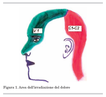 Neurostimolazione elettrica subcutanea del nervo periferico utilizzata nel  controllo della nevralgia occipitale refrattaria