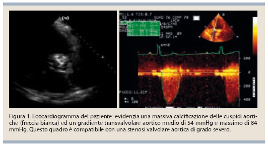 eco doppler per stenosi aortica